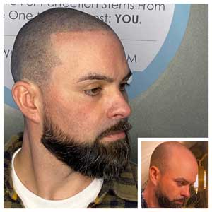 scalp micropigmentation mendham nj before and after